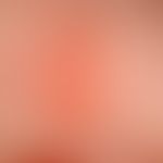 Mastocytosis: Cutaneous mastocytoma of the infant, beginning central blister formation after slig...