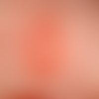 Mastozytose.&nbsp;Kutanes Mastozytom des Säuglings. Beginnende zentrale Blasenbildung nach leicht...