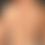 Multiple Mastozytome:&nbsp;disseminierte, flächige bräunlich-rötliche, bei Wärme und traumatische...