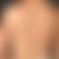 Multiple mastocytomas:disseminated, flat, brownish-reddish spots and plaques on the trunk and ext...