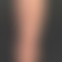 Melanoma malignes: multiple cutaneous melanoma metastases in pre-operated nodular melanoma of the...