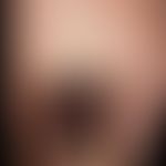 Melanonychia: homogeneous brown-black discoloration of the big toe nail in the case of proven mal...