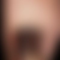 Melanonychie: homogene Braunschwarzverfärbung des Großzehennagels bei nachgewiesenem maligenem Me...
