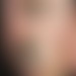 DD: Melanom malignes akrolentiginöses:&nbsp;hier: komplizierende&nbsp;Onychomykose mit Einblutung...