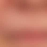 Melkersson-Rosenthal syndrome: detailed picture after 2 years of long-term therapy

&nbsp;

