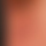 Mycosis fungoides tumor stage: Mycosis fungoides has been known for years, for about 3 months the...