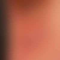 Mycosis fungoides tumor stage: Mycosis fungoides has been known for years, for about 3 months the...