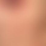 Mycosis fungoides tumor stage: long-term known Mycosis fungoides: recurrent plaques and nodules, ...