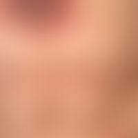 Mycosis fungoides tumor stage: long-term known Mycosis fungoides: recurrent plaques and nodules, ...