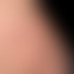 Mycosis fungoides tumor stage: Mycosis fungoides has been known for many years, and for several m...
