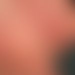 Mycosis fungoides tumor stage: Mycosis fungoides has been known for years, for about 3 months the...