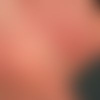 Mycosis fungoides tumor stage: Mycosis fungoides has been known for years, for about 3 months the...
