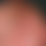 Mycosis fungoides tumor stage: Mycosis fungoides has been known for many years, and for several m...