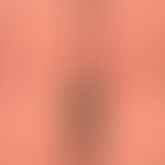 Mycosis fungoides tumor stage: Mycosis fungoides has been known for years, for about 3 months the...