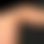Naevus flammeus: kongenitale, völlig symptomlose vaskuläre Malformation (ausschließlich kapilläre...