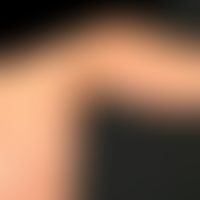 Naevus flammeus: kongenitale, völlig symptomlose vaskuläre Malformation (ausschließlich kapilläre...