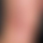 Narbe atrophische: ältere großflächige Narbe mit fibrotischen Narbensträngen.
