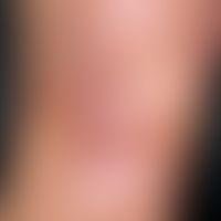 Narbe atrophische: ältere großflächige Narbe mit fibrotischen Narbensträngen.
