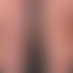 Narbe atrophische: flächenhafte Atrophie der Haut nach langjährigem Gebrauch von systemischen Glu...