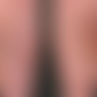 Narbe atrophische: flächenhafte Atrophie der Haut nach langjährigem Gebrauch von systemischen Glu...