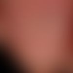 Nail: hyperkeratotic cuticle with fresh and older bleeding, increased longitudinal ribbing of the...