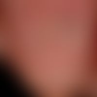 Nail: hyperkeratotic cuticle with fresh and older bleeding, increased longitudinal ribbing of the...