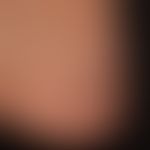 Typ I Neurofibromatose (peripherer Typ):&nbsp;Zahlreiche&nbsp; weiche Papeln und Knoten.&nbsp;
