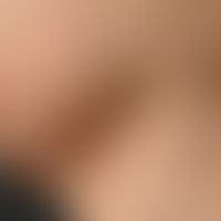 Neurofibromatosis peripheral: multiple soft, skin-coloured nodules and nodules that can be presse...