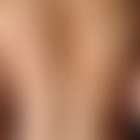 Neurofibromatosis periphere: multiple, disseminated smaller and larger neurofibromas in skin and ...