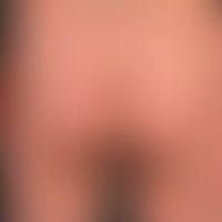 Psoriasis vulgaris. general view: multiple, solitary or confluent, nummular, also confluent, eryt...