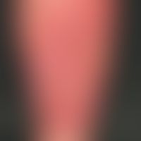 Papillomatosis cutis lymphostatica:&nbsp;flächenhafte,&nbsp;nach distal scharf begrenzte, nach pr...