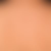 Prurigo gestationis: 32-year-old female patient in the 6th month of pregnancy with increasing, se...