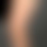 Pruritus brachioradialer:&nbsp;häufig auftretender unangenehm stechender Juckreiz an den streckse...