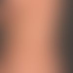 Pityriasis versicolor alba:&nbsp;regellos verteilte, symptomlose,&nbsp;helle Flecken, die stellen...