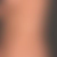 Pityriasis versicolor alba: irregularly distributed, symptomless, bright spots, which in places h...