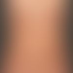 Atrophodermia idiopathica et progressiva. chronic stationary, map-like spread, strictly symmetric...