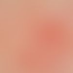 Teleangiectasia: linear and reticularly branched, partly uniformly, partly also sinusoidally dila...
