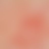 Teleangiectasia: linear and reticularly branched, partly uniformly, partly also sinusoidally dila...