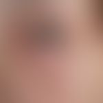 Blepharochalasis: initial findings.

