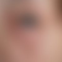 Blepharochalasis: initial findings.
