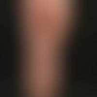 Malformationen, syndromale vaskuläre: Naevus flammeus (kapilläre Malformation, keine arterio-venö...