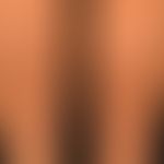 Erythema nodosum: &nbsp;im Abklingen begriffener Befund mit schuppenden, kaum mehr schmerzhaften ...