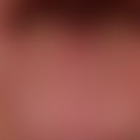Glossitis mediana rhombica: Detailaufnahme der Zungenoberfläche.&nbsp;
