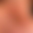 Impetigo contagiosa: an itchy, crusty, weeping finding of the bridge of the nose that has been pr...