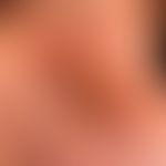 Impetigo contagiosa: an itchy, crusty, weeping finding of the bridge of the nose that has been pr...