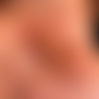 Impetigo contagiosa: seit mehreren Wochen bestehender, juckender, krustig-nässender Befund des Na...