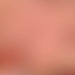 Lentigo solaris: bizarrely configured, brown-black spot; in the centre dark irregular part (see i...