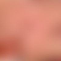 Lentigo solaris: bizarrely configured, brown-black spot; in the centre dark irregular part (see i...