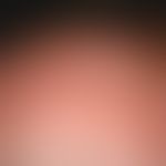 Keratosis actinica:&nbsp;Nebeneinander von weißen Flecken (flache Vernarbungen) und keratotischen...