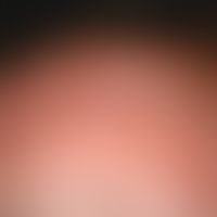 Keratosis actinica:&nbsp;Nebeneinander von weißen Flecken (flache Vernarbungen) und keratotischen...